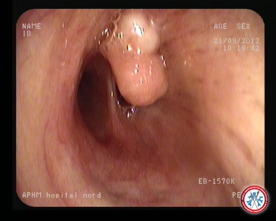 Obstructing the right lower lobe